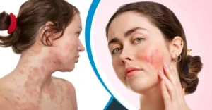 গরমের র্যাশ ও ফাঙ্গাল ইনফেকশন দূর হবে জাদুকরী ৬ উপায়ে! দ্রুত উপশম পাবেন শরীরের গোপন অস্বস্তি থেকে